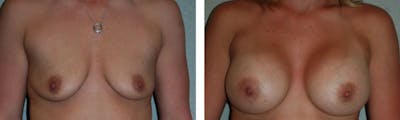 Breast Augmentation Before & After Gallery - Patient 176791870 - Image 1