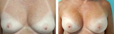 Breast Augmentation Before & After Gallery - Patient 176791898 - Image 1
