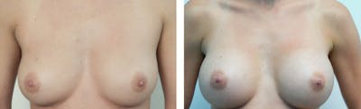 Breast Augmentation Before & After Gallery - Patient 176791946 - Image 1