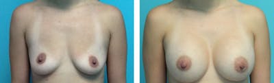 Breast Augmentation Before & After Gallery - Patient 176791976 - Image 1