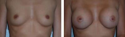 Breast Augmentation Before & After Gallery - Patient 176791988 - Image 1