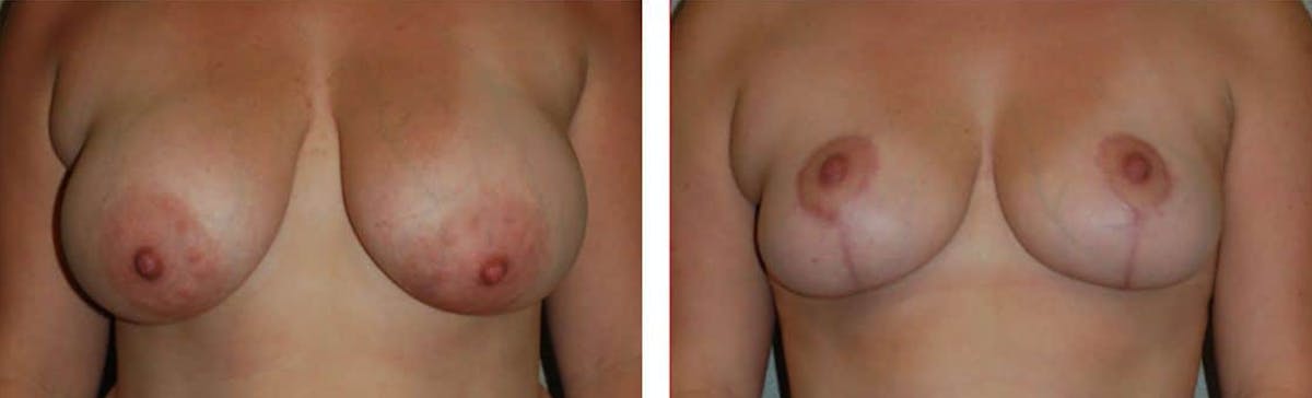 Breast Lift Before & After Gallery - Patient 176792292 - Image 1