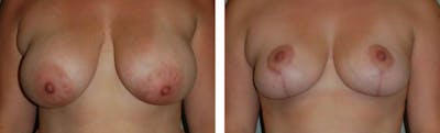 Breast Lift Before & After Gallery - Patient 176792292 - Image 1