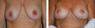 Breast Lift Before & After Gallery - Patient 176792317 - Image 1