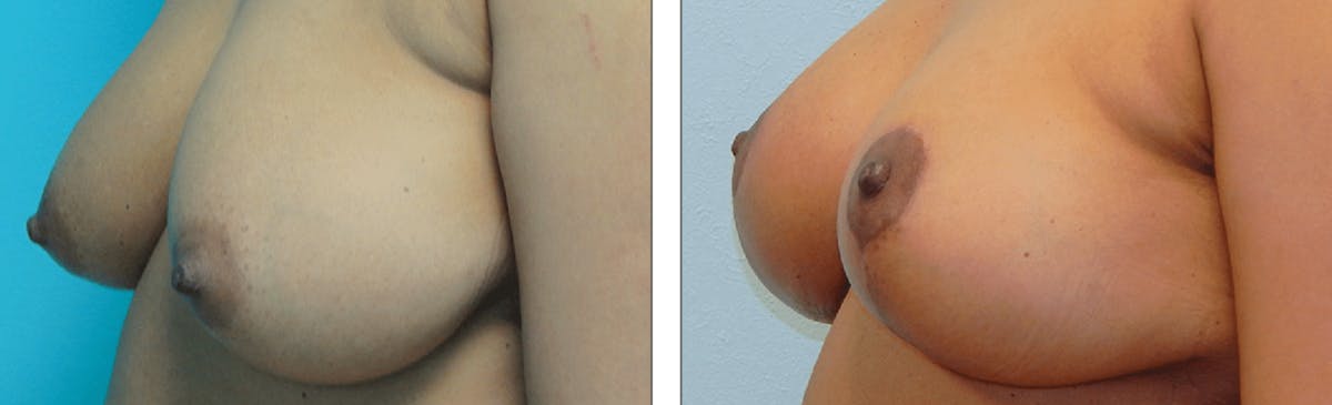 Breast Lift Before & After Gallery - Patient 176793775 - Image 2
