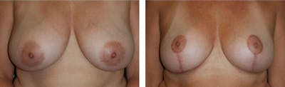 Breast Reduction Before & After Gallery - Patient 176795131 - Image 1