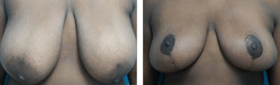 Breast Reduction Before & After Gallery - Patient 176795133 - Image 1
