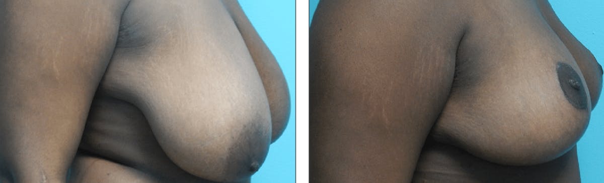 Breast Reduction Before & After Gallery - Patient 176795133 - Image 2