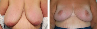 Breast Reduction Before & After Gallery - Patient 176795135 - Image 1