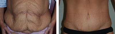 Tummy Tuck Before & After Gallery - Patient 176795168 - Image 1