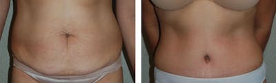 Tummy Tuck Before & After Gallery - Patient 176795176 - Image 1