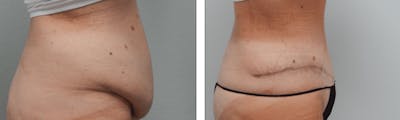 Tummy Tuck Before & After Gallery - Patient 176795184 - Image 1