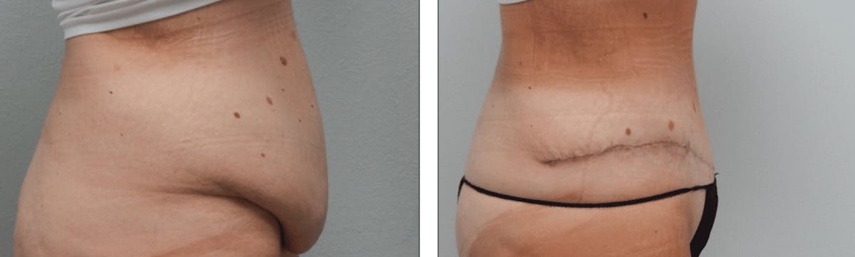 Tummy Tuck Before & After Gallery - Patient 176795184 - Image 1