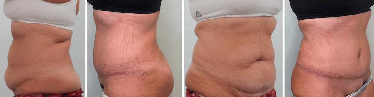 Tummy Tuck Before & After Gallery - Patient 176795194 - Image 1