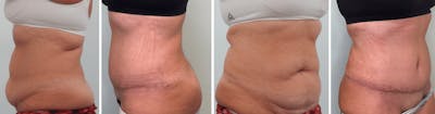 Tummy Tuck Before & After Gallery - Patient 176795194 - Image 1