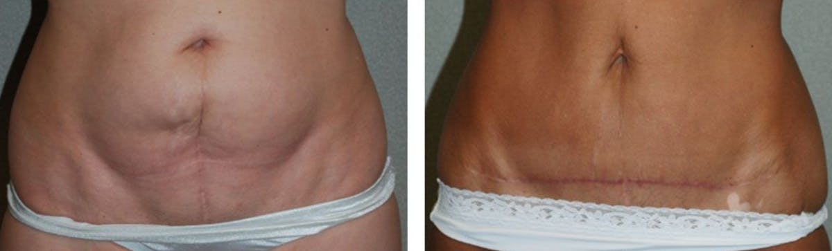 Tummy Tuck Before & After Gallery - Patient 176795198 - Image 1