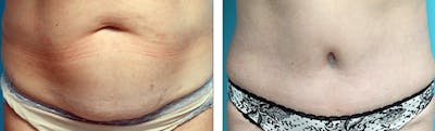 Tummy Tuck Before & After Gallery - Patient 176795204 - Image 1