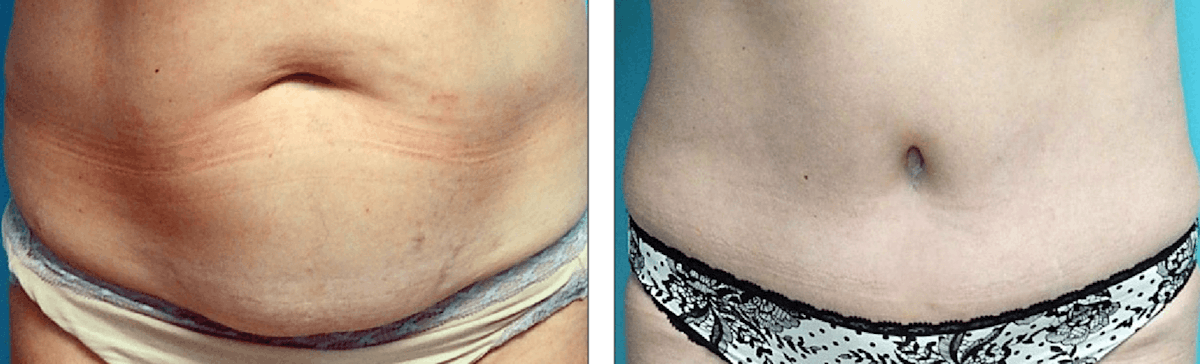 Tummy Tuck Before & After Gallery - Patient 176795204 - Image 1