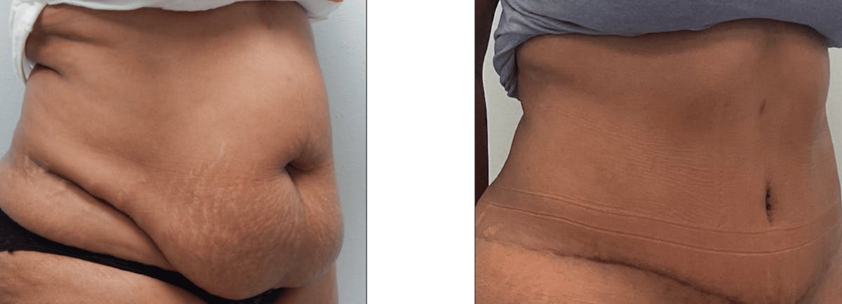 Tummy Tuck Before & After Gallery - Patient 176795210 - Image 1