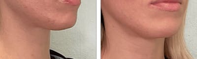 Submental Liposuction Before & After Gallery - Patient 176795224 - Image 1