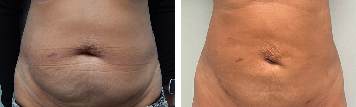 Tummy Tuck Before & After Gallery - Patient 226974 - Image 1