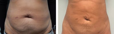 Tummy Tuck Before & After Gallery - Patient 226974 - Image 1