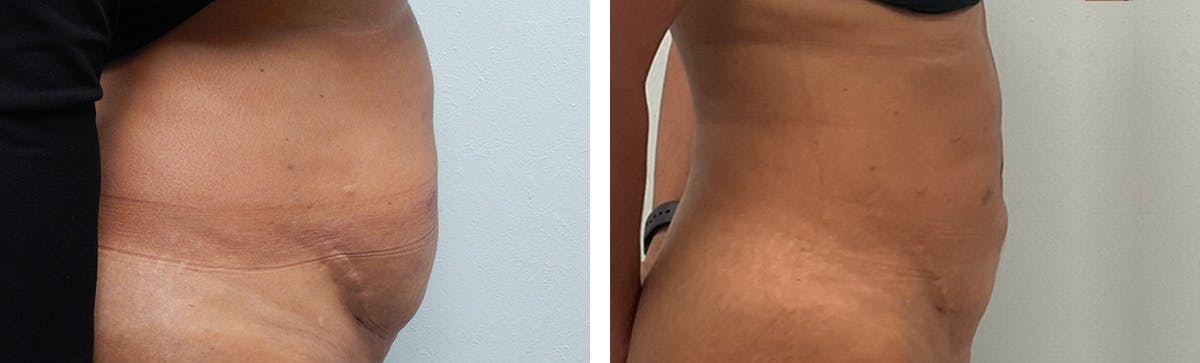 Tummy Tuck Before & After Gallery - Patient 226974 - Image 3