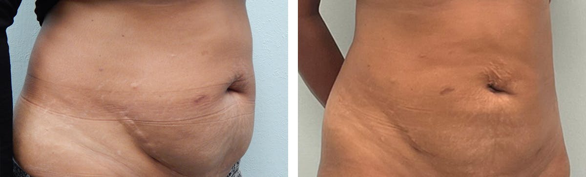 Tummy Tuck Before & After Gallery - Patient 226974 - Image 2