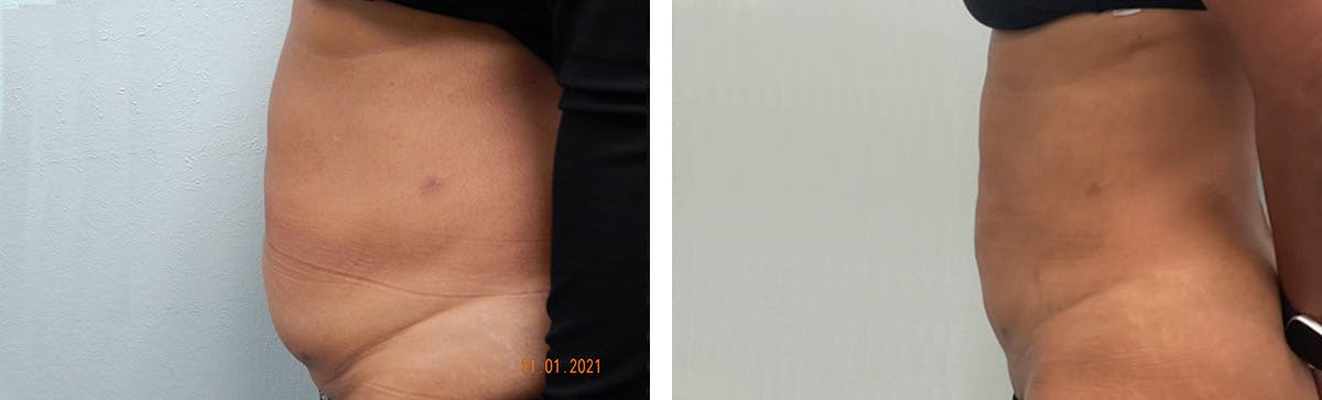 Tummy Tuck Before & After Gallery - Patient 226974 - Image 5
