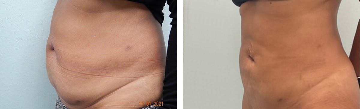 Tummy Tuck Before & After Gallery - Patient 226974 - Image 4