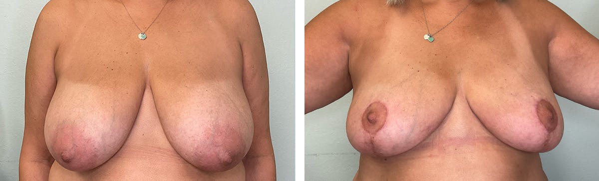 Breast Reduction Before & After Gallery - Patient 234029 - Image 1