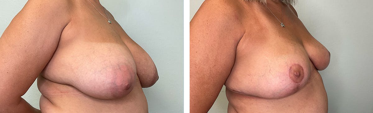 Breast Reduction Before & After Gallery - Patient 234029 - Image 2
