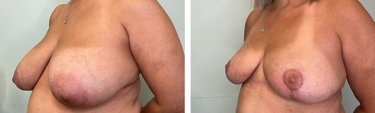 Breast Reduction Before & After Gallery - Patient 234029 - Image 4