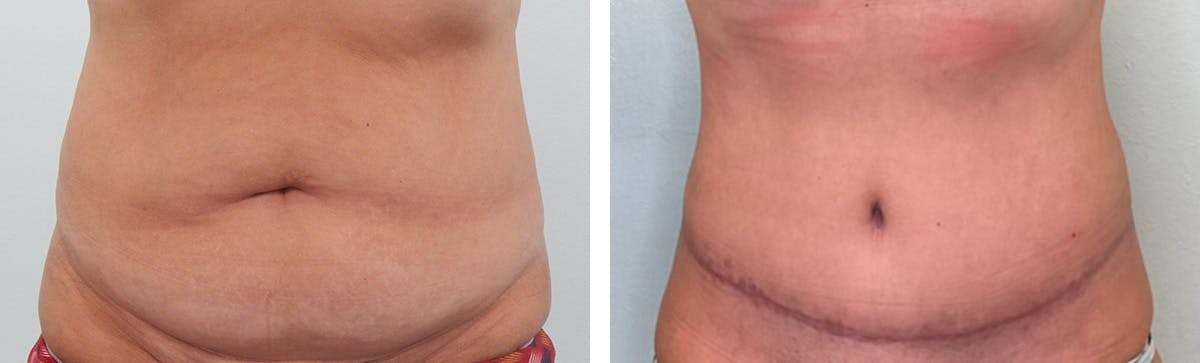 Liposuction Before & After Gallery - Patient 853317 - Image 1