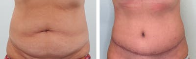 Liposuction Before & After Gallery - Patient 853317 - Image 1