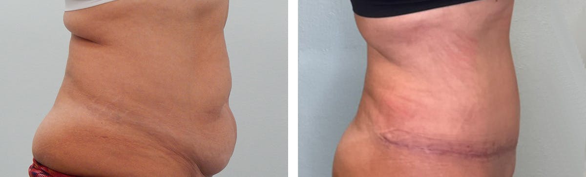 Tummy Tuck Before & After Gallery - Patient 255804 - Image 3