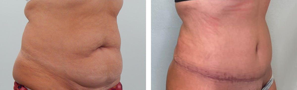 Tummy Tuck Before & After Gallery - Patient 255804 - Image 2