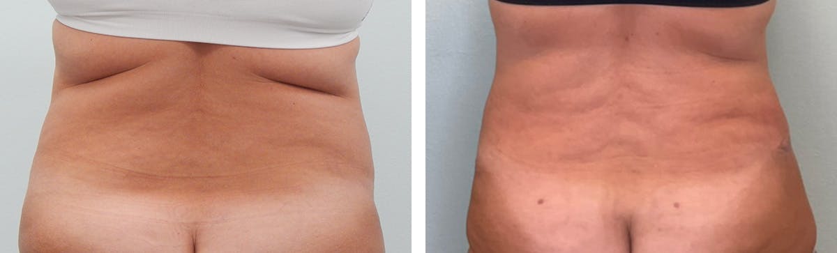 Tummy Tuck Before & After Gallery - Patient 255804 - Image 6