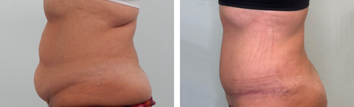 Liposuction Before & After Gallery - Patient 853317 - Image 5