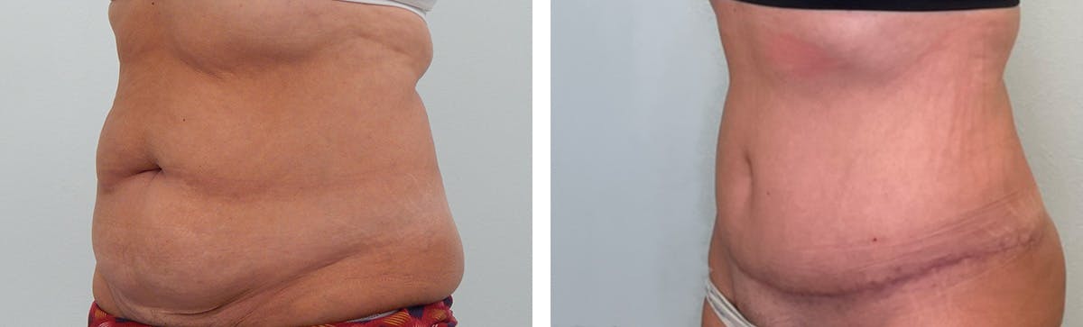 Tummy Tuck Before & After Gallery - Patient 255804 - Image 4