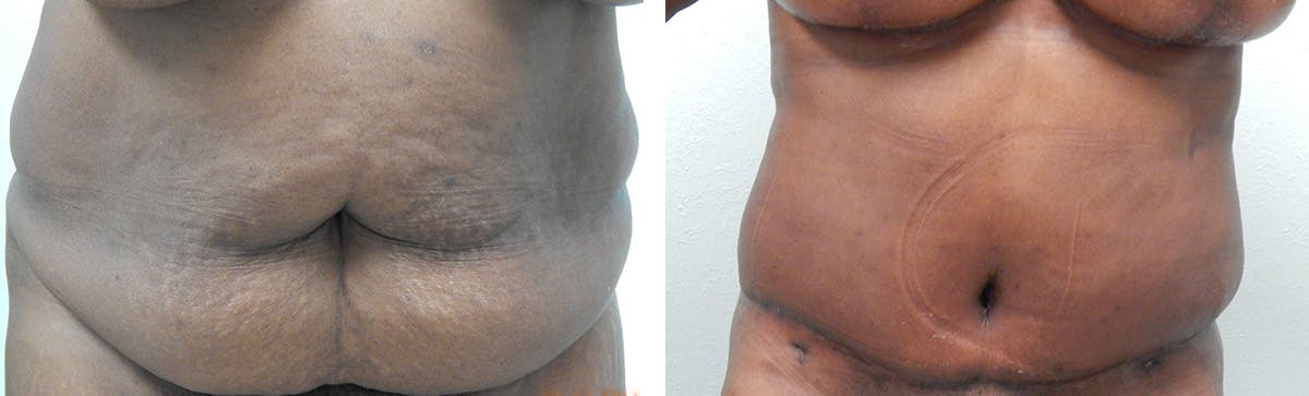 Tummy Tuck Before & After Gallery - Patient 636958 - Image 1