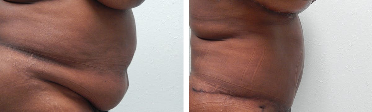 Tummy Tuck Before & After Gallery - Patient 636958 - Image 3