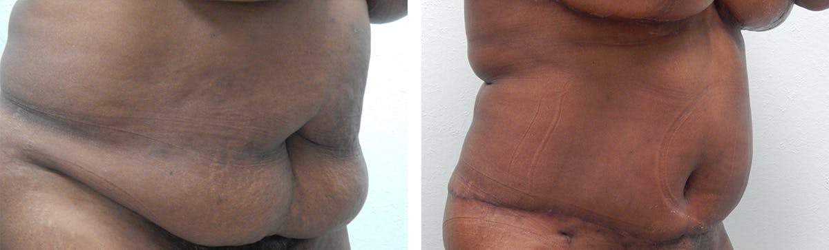 Tummy Tuck Before & After Gallery - Patient 636958 - Image 2