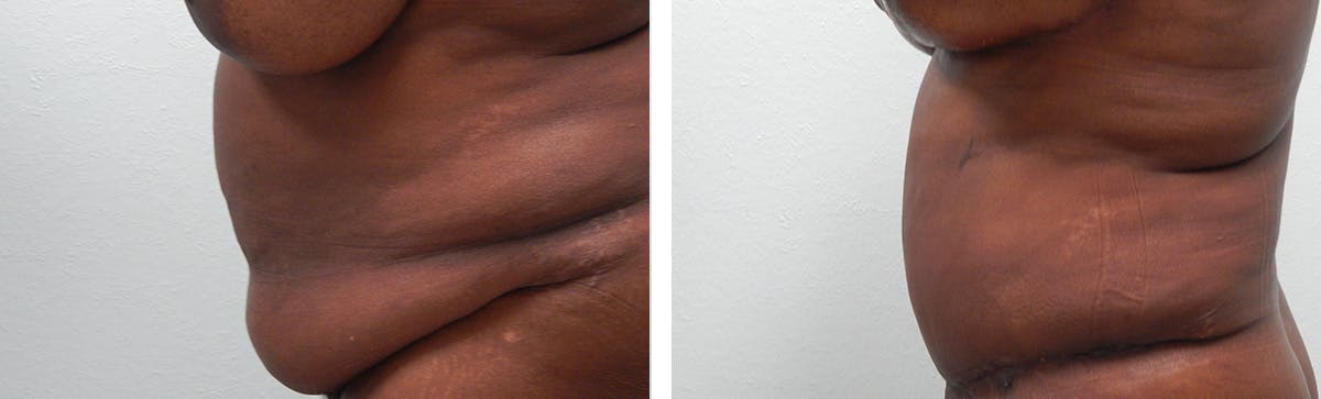 Tummy Tuck Before & After Gallery - Patient 636958 - Image 5
