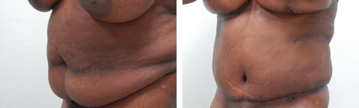 Tummy Tuck Before & After Gallery - Patient 636958 - Image 4
