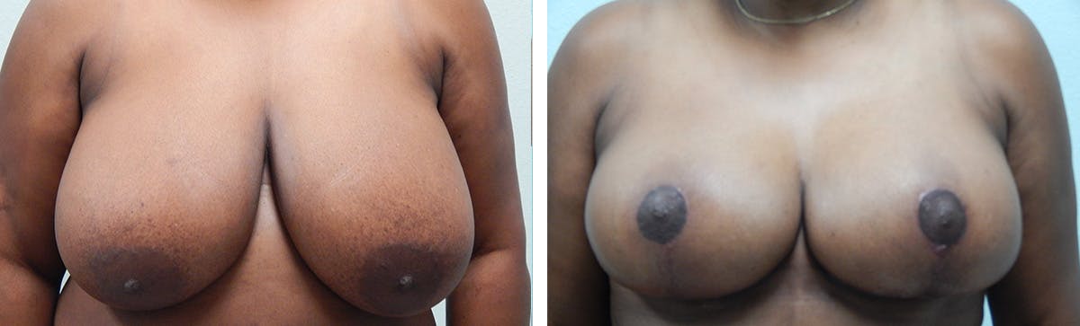 Breast Reduction Before & After Gallery - Patient 134630 - Image 1