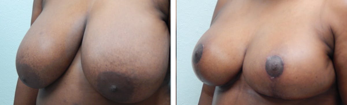 Breast Reduction Before & After Gallery - Patient 134630 - Image 3