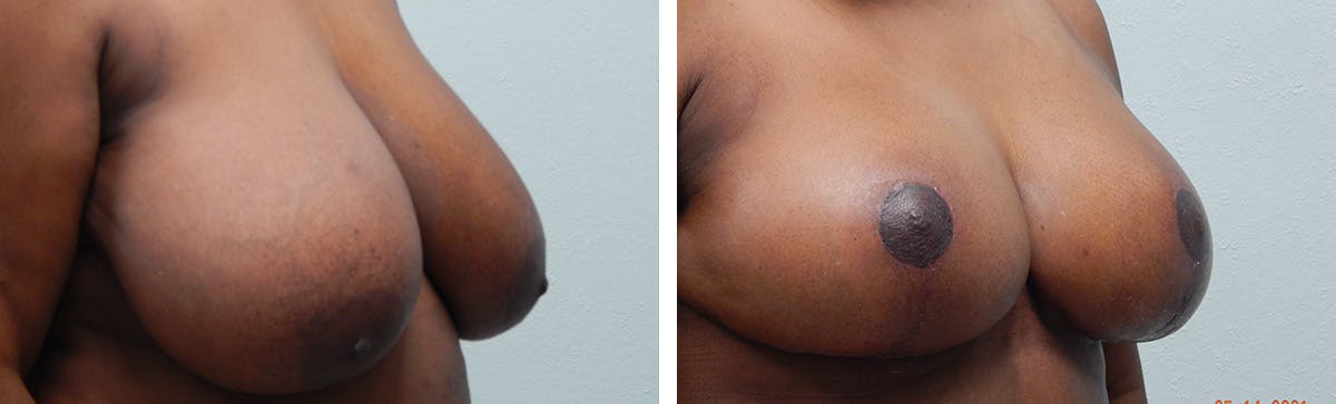 Breast Reduction Before & After Gallery - Patient 134630 - Image 2