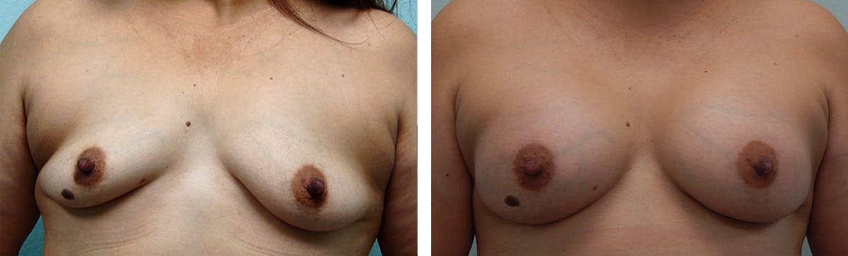 Breast Augmentation Before & After Gallery - Patient 192935 - Image 1