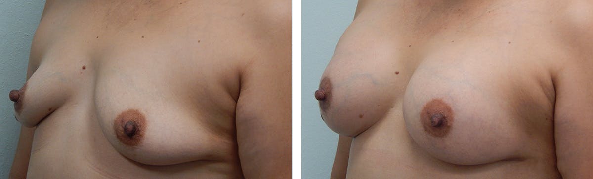 Breast Augmentation Before & After Gallery - Patient 192935 - Image 3